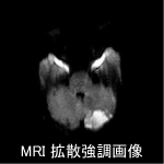 MRI拡散強調画像